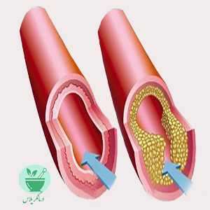 علت تنگ شدن عروق خونی